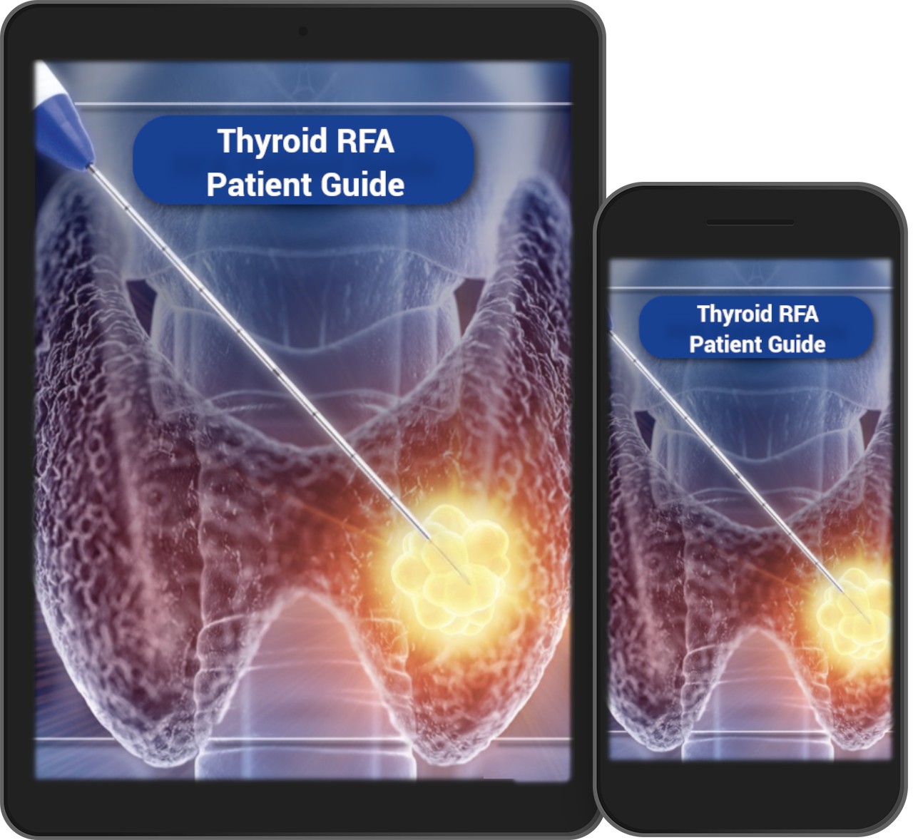 Free Thyroid Radiofrequency Patient Guide